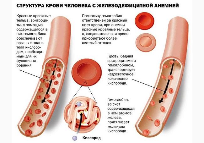 Из-за анемии (малокровия) у человека уменьшается количество красных кровяных телец