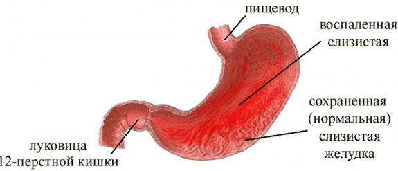 Особенности хронического гастрита