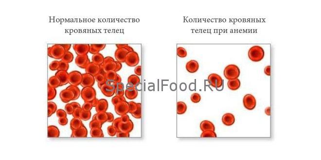 Анемия 