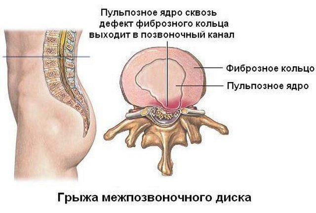 Межпозвоночный диск, несмотря на свою прочность, все же может повредиться, в результате чего возникнет грыжа