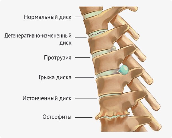 Какие симптомы межпозвонковой грыжи