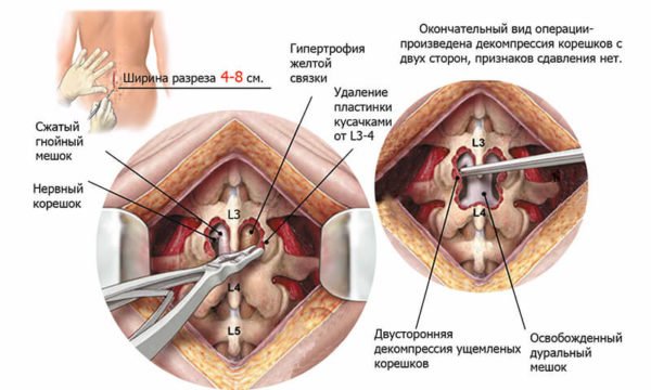 Удаление межпозвоночной грыжи