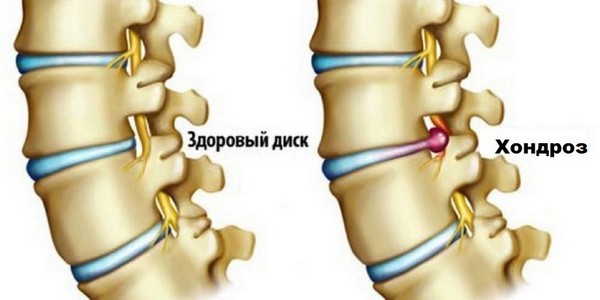 Хондроз может развиться как из-за иных заболеваний позвоночника, так и из-за неправильного образа жизни