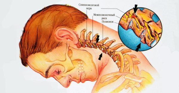 Хондроз нарушает кровообращение не только в шее, но и мозге