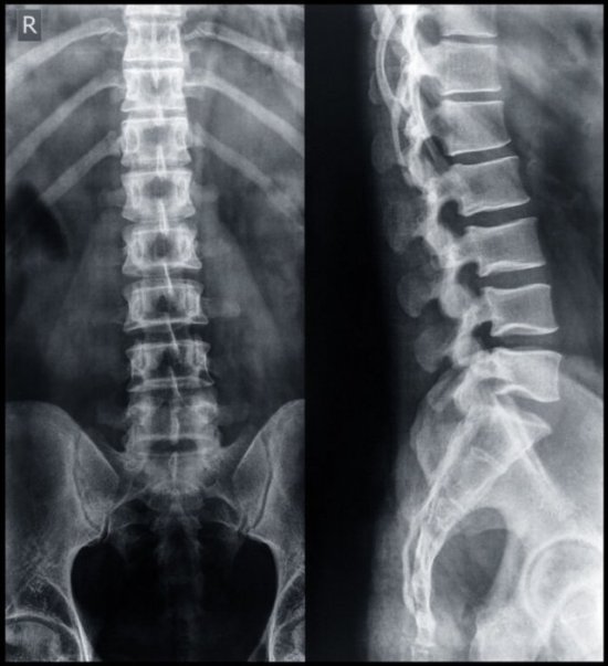 Рентген позвоночника