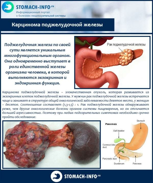 Карцинома поджелудочной железы