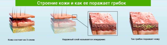 Микоз стоп лечение