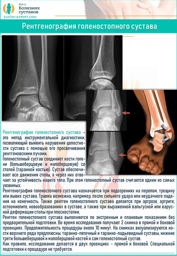 Диагноз голеностопный сустав