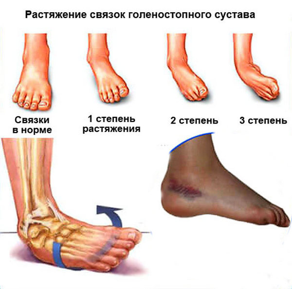 Степени растяжения связок голеностопа