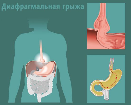 Диафрагмальная грыжа