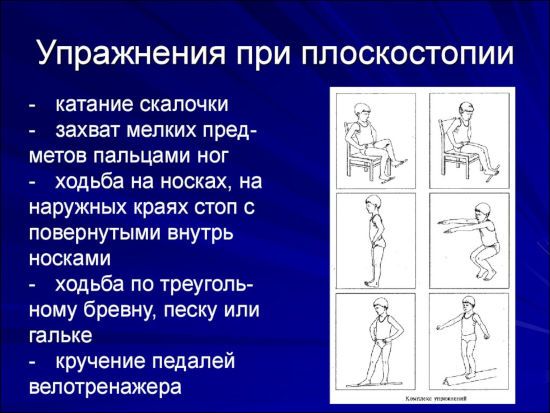 Упражнения при плоскостопии