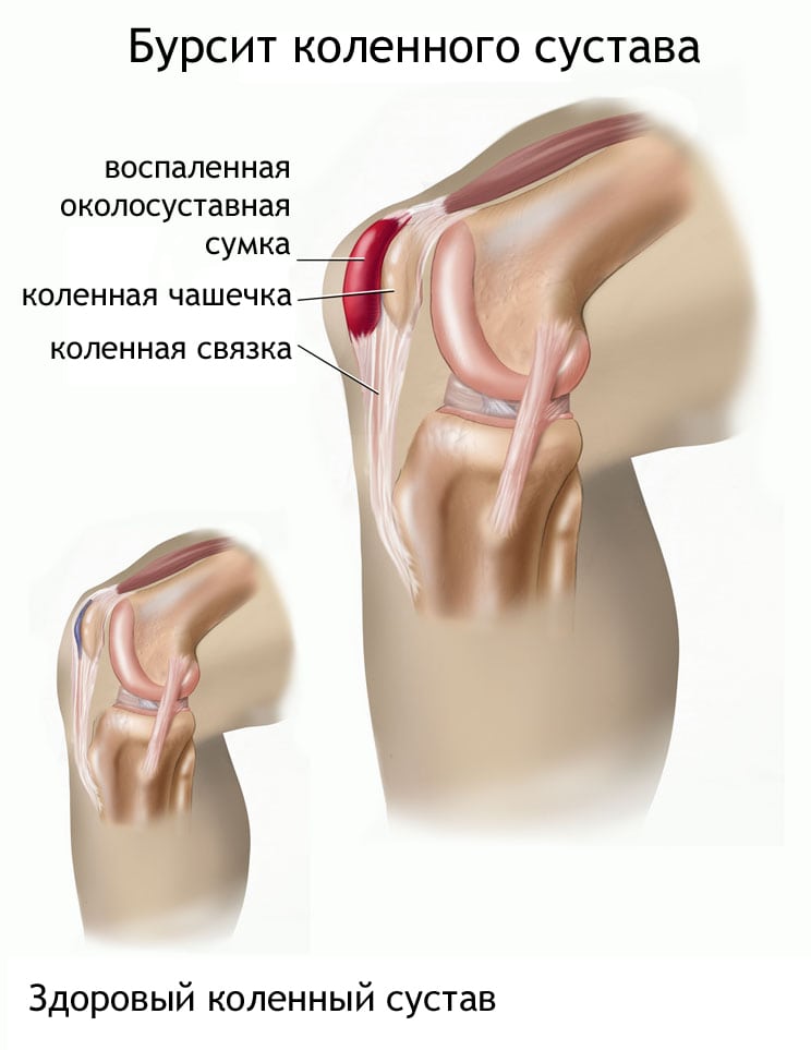 Разрыв мениска