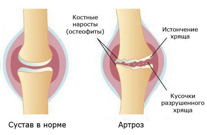 Артроз сустава 