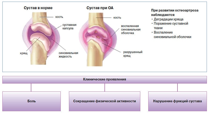 Боль в кисти