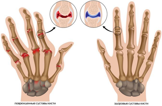 Артрит пальцев рук