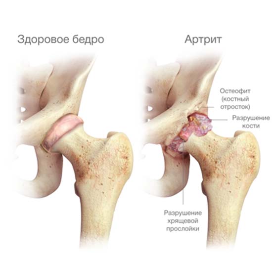 Артрит тазобедренного сустава