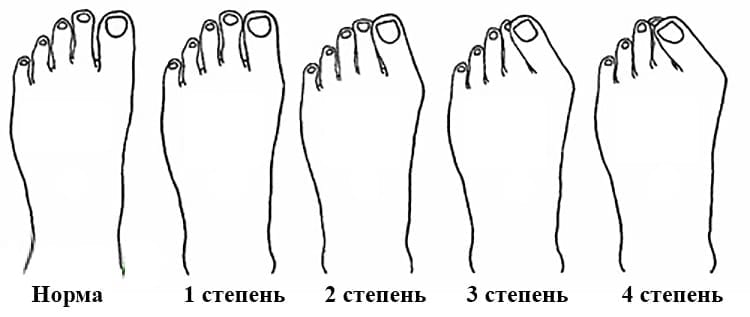 Какие бывают пальцы ног. Правильное положение большого пальца на ноге. Правильное расположение пальцев на стопе. Правильное положение пальцев стопы. Правильная стопа ,расположение пальцев ног.