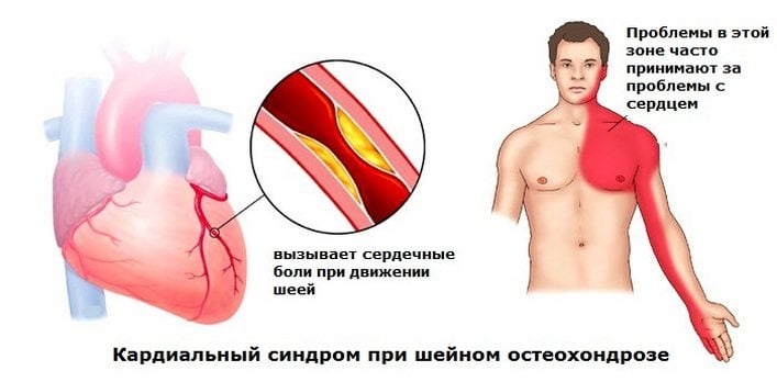 Кардиальный синдром