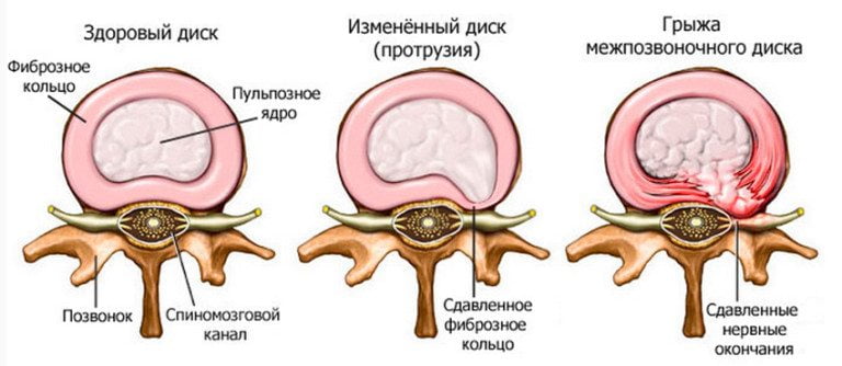 Межпозвоночная грыжа