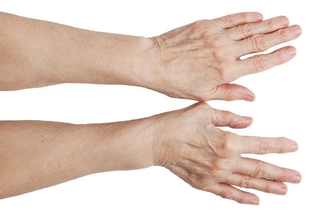 На суставе большого пальца руки образовалась шишка как ее лечить: диагностика и лечение, лечение, причины и диагностика, проявления