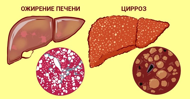 лечение печени травами фото