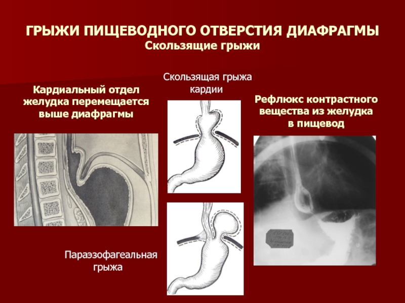 Грыжи пищеводного отверстия диафрагмы презентация по хирургии