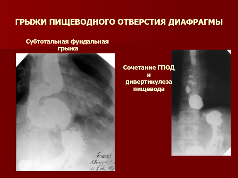 Эндоскопическая картина при грыжах пищеводного отверстия диафрагмы характеризуется