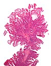 Peutz-Jeghers syndrome polyp.jpg