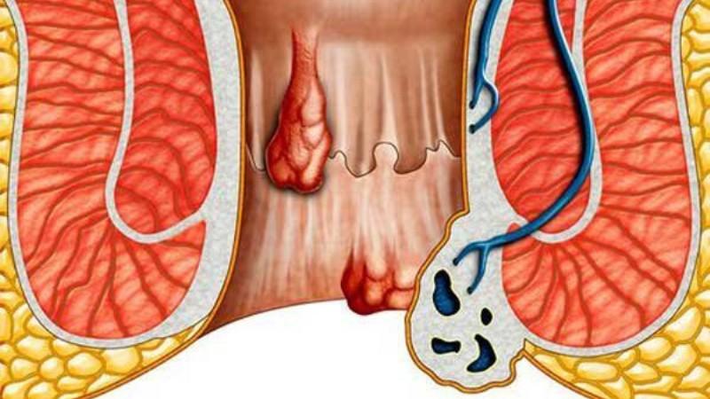 В заднем проходе появилась шишка: как лечить