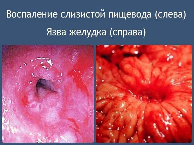 Воспаление слизистой оболочки пищевода