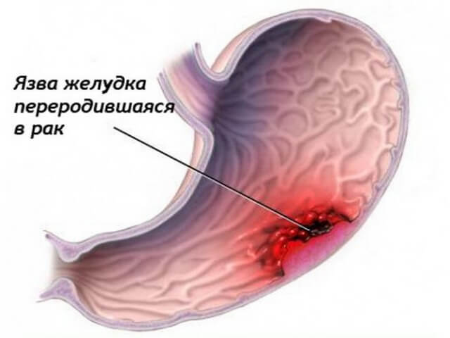 Запущенная язва желудка