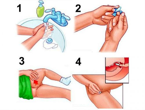 Правила постановки ректальных свечей