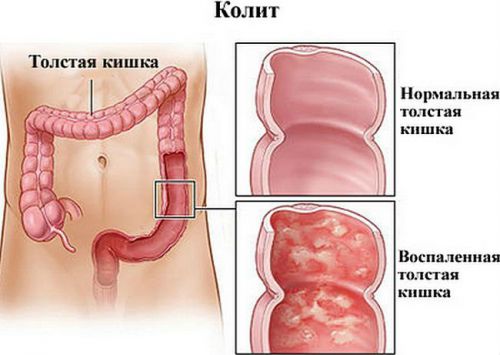 Колит