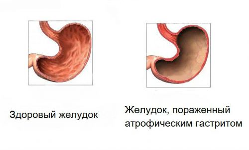 Атрофический гастрит