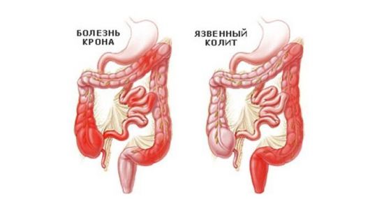 Болезнь Крона и язвенный колит