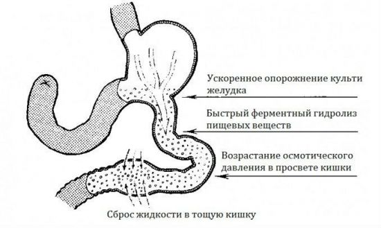 Демпинг-синдром