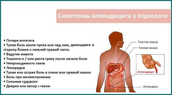 Симптомы аппендицита у взрослых