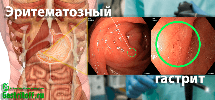 Эритематозный гастрит желудка на снимках ФГДС