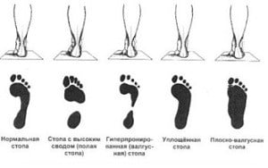 массаж при плоскостопии стопа