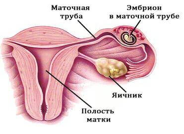 Внематочная беременность