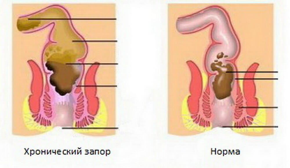 Хронический запор и норма