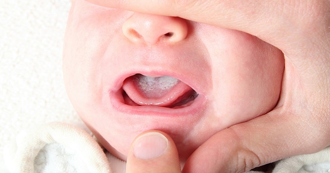 Белый налет на языке у ребенка – безобидные причины и опасные признаки
