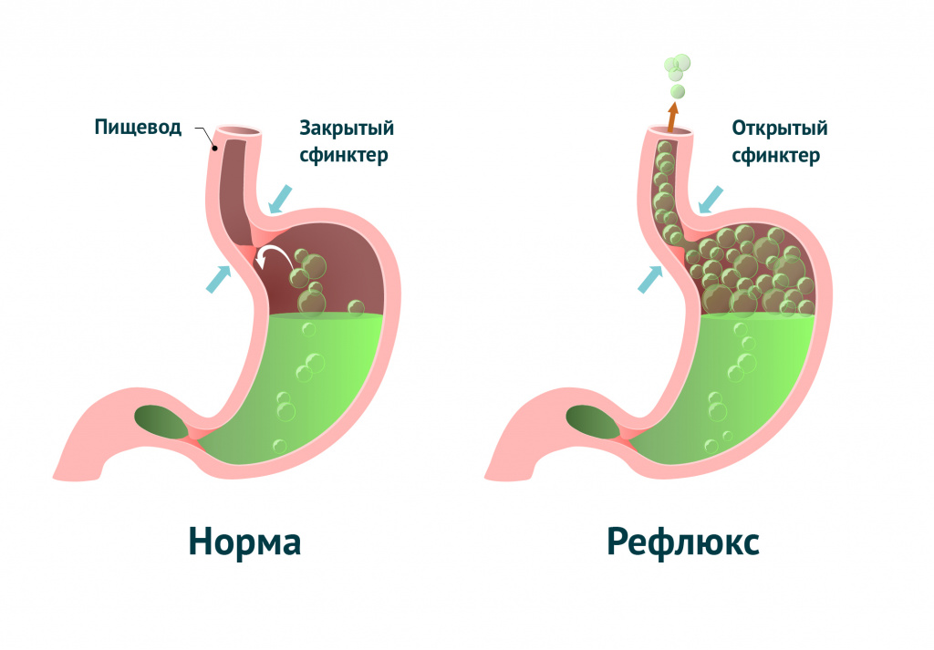 Гастроэзофагеальная рефлюксная болезнь.jpg