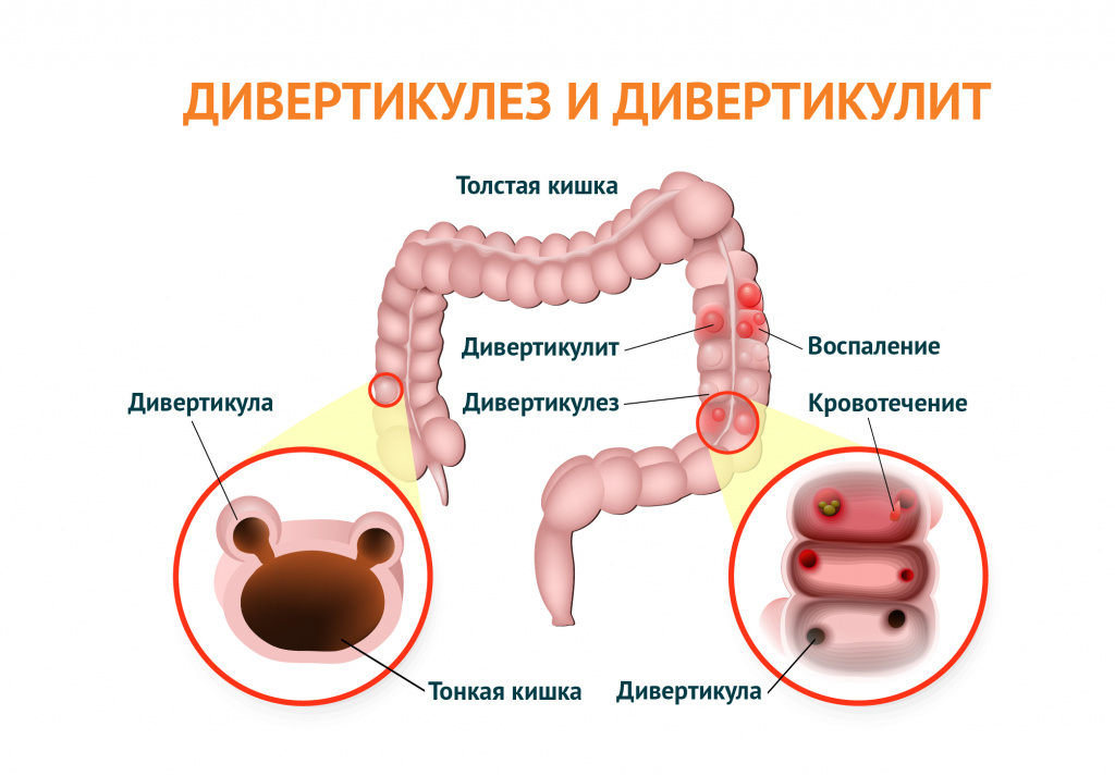 Дивертикулит и дивертикулез.jpg