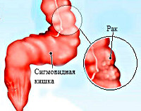 Рак сигмовидной кишки