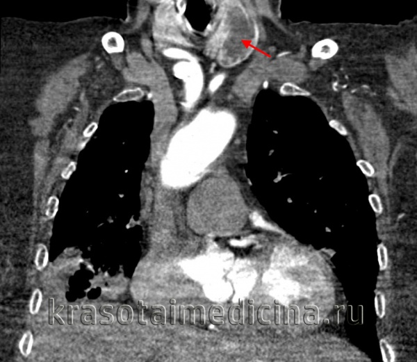 КТ ОГК с контрастированием. Диффузное увеличение щитовидной железы с наличием большого гиподенсного узла в левой доле.