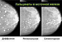 Кальцинаты молочных желез