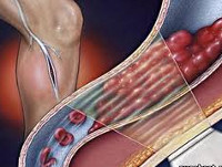 Тромбофлебит