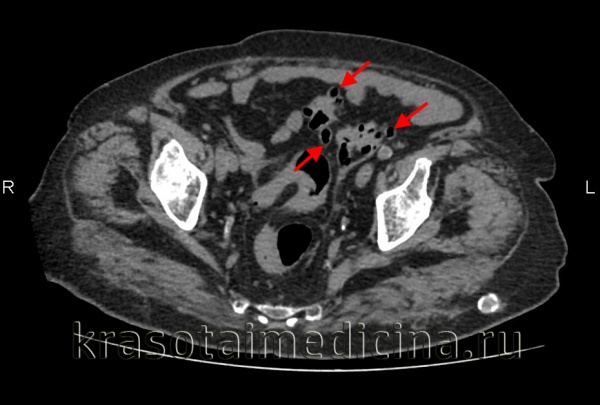КТ органов брюшной полости. Множественные дивертикулы сигмовидной кишки, заполненные газом