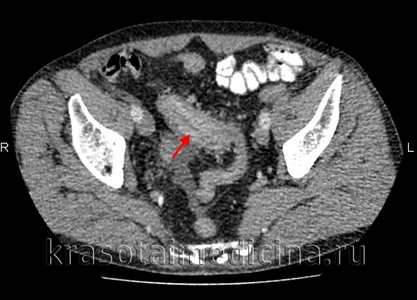 КТ органов брюшной полости. Мягкотканное утолщение стенки сигмовидной кишки, накопление контраста в ней, регионарная лимфаденопатия